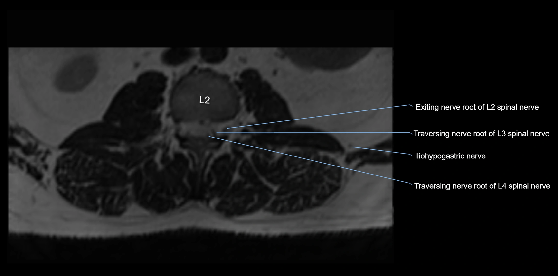 MR lumbosacral plexus axial cross sectional anatomy 3T  radiology  image-img-1008001-00005.webp
